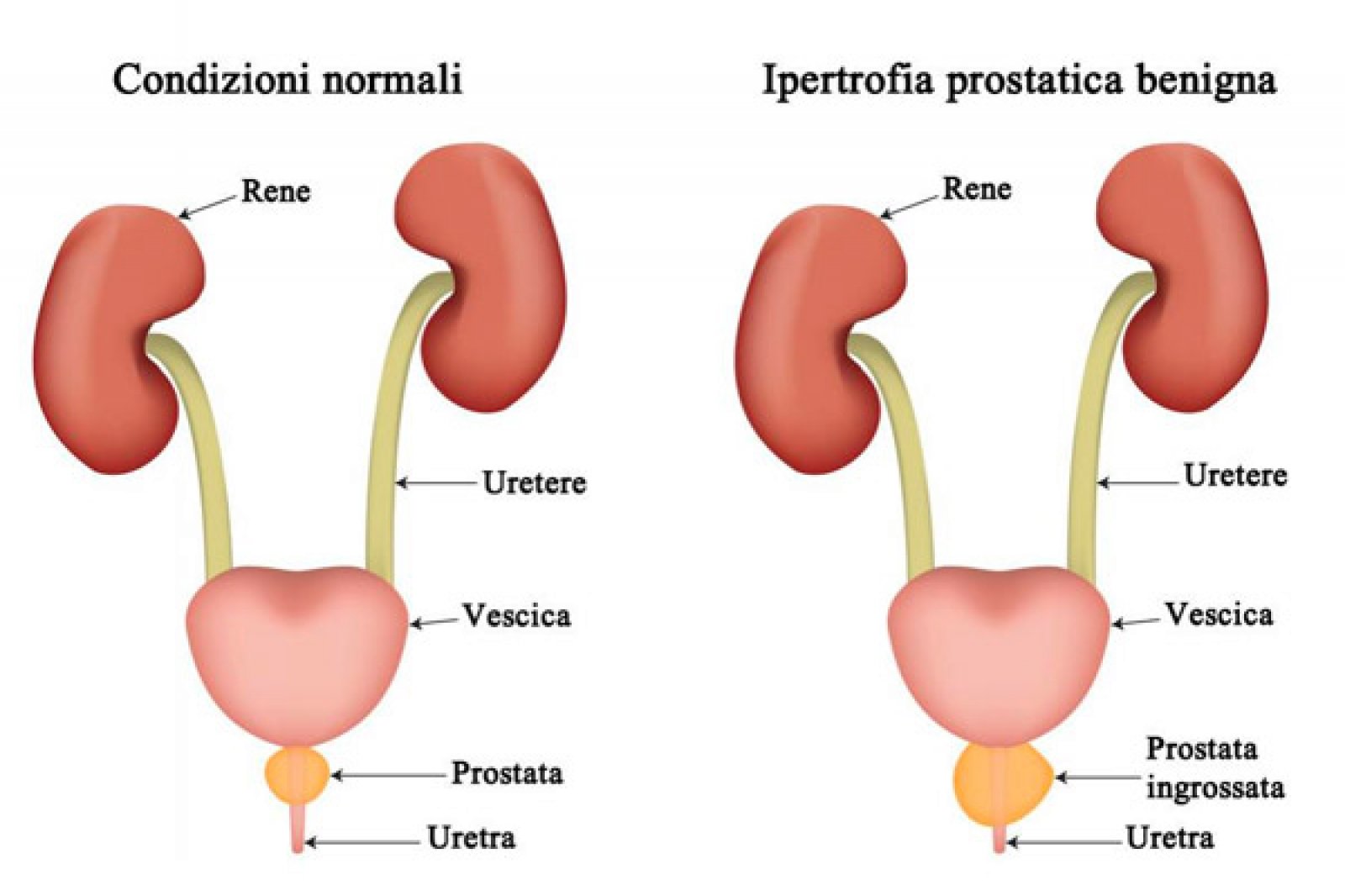 próstata mediante examen de sangre prostagood pentru prostată